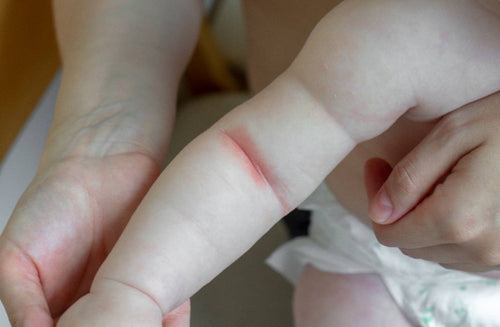 Baby Eczema: What Parents Need to Know