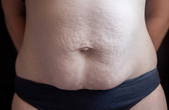 What Is Diastasis Recti—and How Do I Fix It?